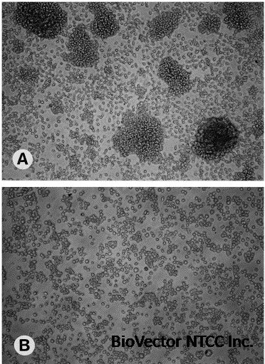 Malignant hematopoietic cell lines:in vitro models for the study of  multiple myeloma and plasma cell leukemia - ScienceDirect