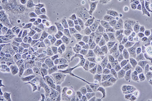 Oestrogen causes neuroblastoma cells to mature into neurons - ecancer